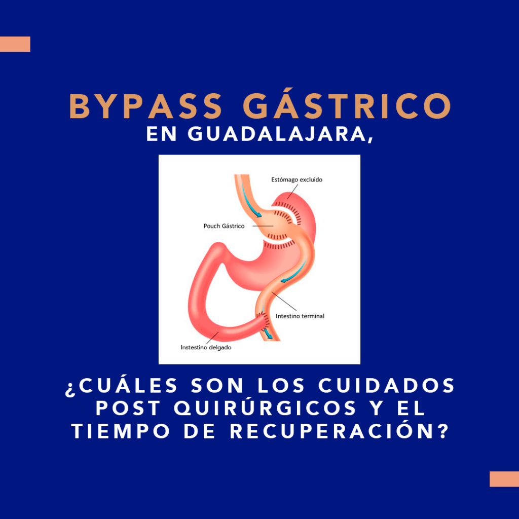 BYPASS GÁSTRICO EN GUADALAJARA